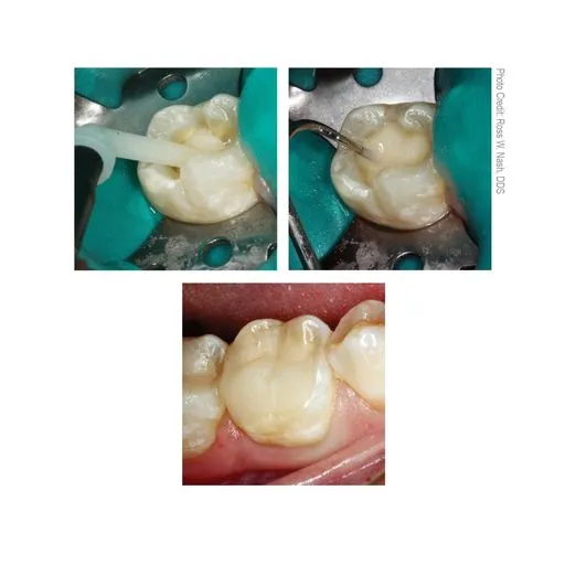 HyperFIL Bulk-Fill Composite - (Universal Shade - A2/B2)